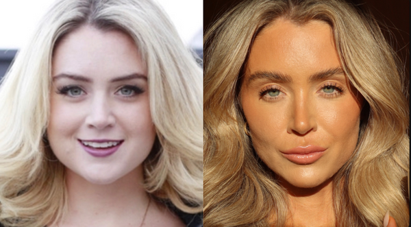 That puffy, moon face look, changed after resetting sugar consumption.