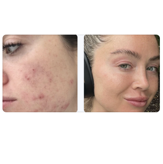 Sam's cystic acne cleared, no creams or potions, but after healing her gut.